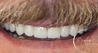 smile-after-fullmouth-01