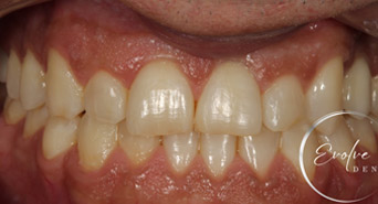 smile-after-invisalign-01