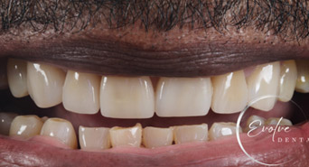 smile-after-veneers-01