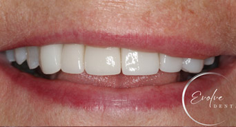 smile-after-veneers-02