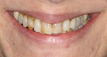smile-before-crown-01