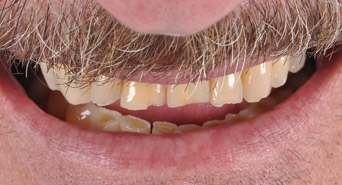 smile-before-fullmouth2-01