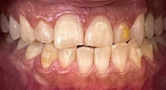 smile-before-invisalign-01