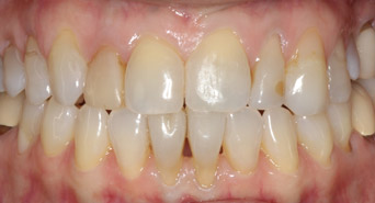 smile-before-veneers-02