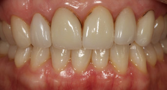 veneers_new_1