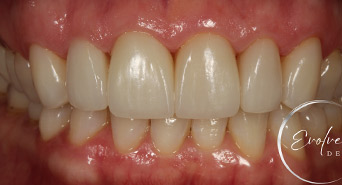 veneers_new_1_after